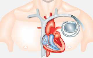 Электрокардиостимулятор показания к установке