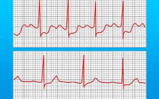 Экг при ибс стенокардия напряжения расшифровка