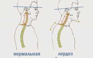 Основные причины развития лордоза шейного отдела позвоночника: лечение  и полезная информация для пациентов