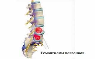 Опасные размеры гемангиомы позвоночника: что это такое и лечение доброкачественного сосудистого образования