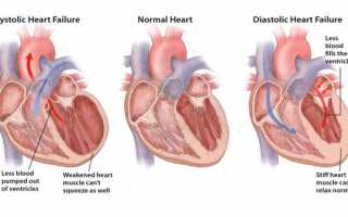 Хроническая сердечная недостаточность причины