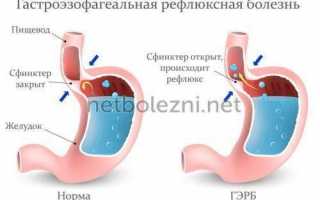 Причины ощущения комка в горле