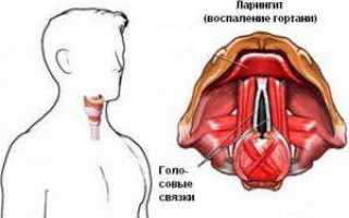 Причины ларингита