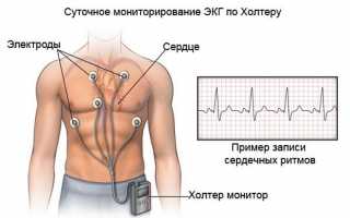 Холтер как выглядит и куда устанавливается