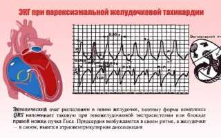 Пароксизмальное нарушение ритма сердца это