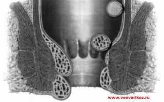 Тромбоз геморроидального узла