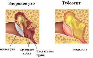 Развитие и симптомы двухстороннего тубоотита