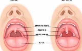 Причины боли в горле с правой стороны при глотании