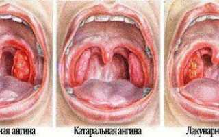Виды ангины у детей