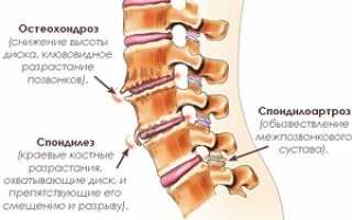 Что такое спондилоартроз: общая информация о заболевании, классификация и стадии недуга, правила лечения