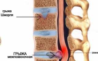 Основные варианты лечения грыжи Шморля поясничного отдела позвоночника и полезные рекомендации специалистов