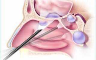 Причины и последствия кисты в носовой пазухе