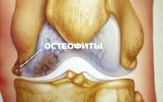 Основные причины появления остеофитов коленного сустава: что это такое и как лечить заболевание