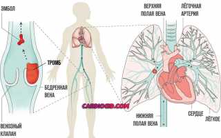 Эмболия легочной артерии симптомы и лечение