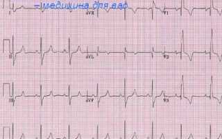 Экг признаки хронического легочного сердца