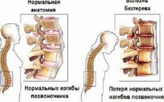 Анкилозирующий спондилоартрит или болезнь Бехтерева у женщин: симптомы и первые признаки, действенные варианты терапии и прогноз