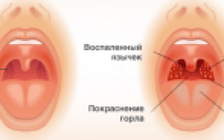 Использование керосина для горла в качестве лечения