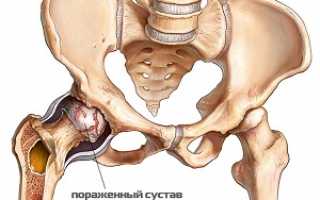Воспалительный процесс с многообразием форм и проявлений — артрит тазобедренного сустава: симптомы и лечение, первая помощь при неожиданном приступе боли