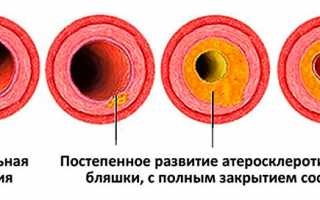 Как растворить холестериновые бляшки в сосудах