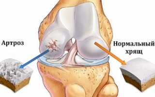 Чем и как лечить артроз коленного сустава в домашних условиях: препараты, ЛФК, самомассаж, народные рецепты и рекомендованная диета