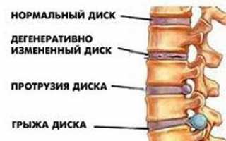 Прогрессирование опасных изменений — протрузии межпозвоночных дисков: что это такое и как лечить болевые ощущения