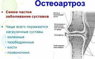 Характерные признаки и симптомы остеоартроза тазобедренного сустава 2 степени: лечение при помощи медикаментов, физио и фитотерапии