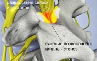 Хронический, опасный и быстро прогрессирующий процесс — стеноз позвоночного канала шейного отдела: консервативная терапия и оперативное вмешательство