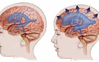 Лечение при внутричерепном давлении у взрослых