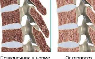 Основные причины развития остеопороза позвоночника: симптомы и лечение, профилактические рекомендации