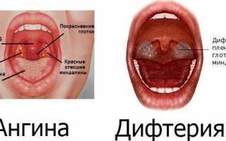 Как проявляется воспаление миндалин в зависимости от формы болезни?