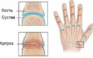 Стадии развития артроза пальцев рук: симптомы и лечение, диагностика и меры профилактики