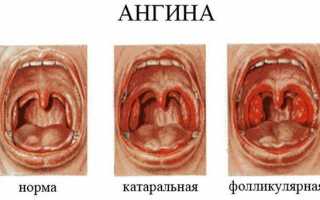 Список таблеток при ангине у взрослых