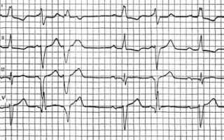 Электросистолы сердца норма у взрослых таблица