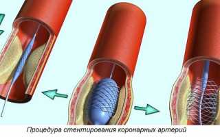 Оформление инвалидности после инфаркта миокарда