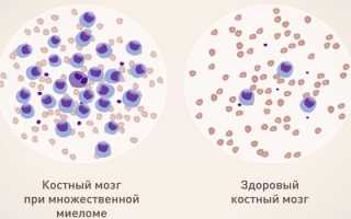 Анализ крови при миеломной болезни показатели