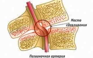 Влияет ли остеохондроз на артериальное давление