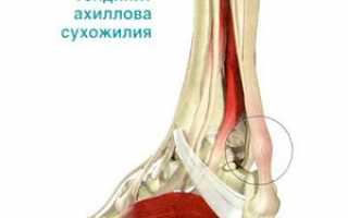 Эффективные методы лечения тендинита ахиллова сухожилия: консервативные варианты терапии, рецепты народной медицины и хирургическое вмешательство