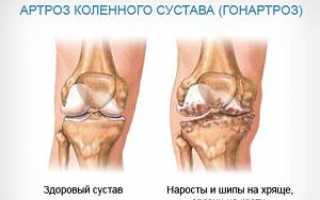 Действенные методы лечения артроза коленного сустава в домашних условиях: проверенные народные рецепты