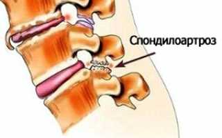 Причины возникновения спондилоартроза поясничного отдела позвоночника: что это такое и как лечить заболевание