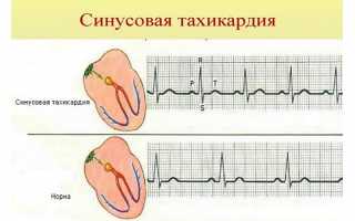 Чем отличается аритмия от тахикардии сердца