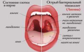 Чем лечить ангину у ребенка 2 лет и обрабатывать горло?