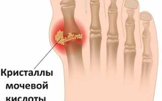 Питание и диета при подагре и повышенной мочевой кислоте: продукты для борьбы с гиперурикемией