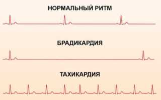 Как снизить высокий пульс при низком давлении