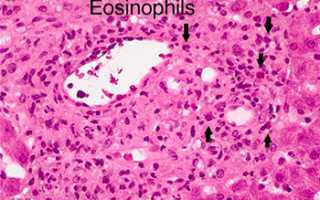 Повышение эозинофилов в крови у мужчин причины