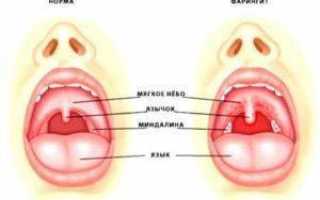Как лечить фарингит у детей в домашних условиях аптечными или народными средствами?