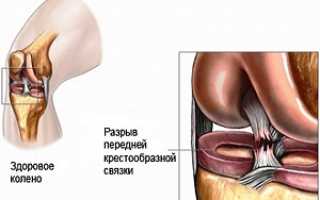 Провоцирующие факторы разрыва передней крестообразной связки коленного сустава: лечение при помощи консервативных методов и оперативного вмешательства