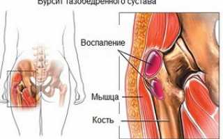 Классификация бурсита тазобедренного сустава: симптомы и причины развития заболевания, общие принципы и варианты терапии