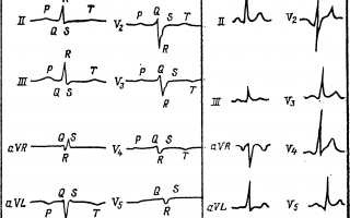 Экг при декстрокардии наложение электродов