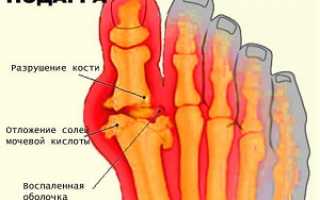 Способы лечения подагры при обострении: эффективные таблетки и мази, народные рецепты против мучительных приступов