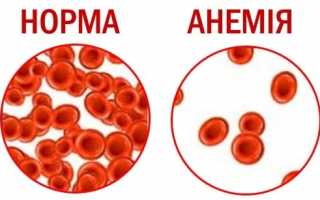 Анемия симптомы и лечение народными средствами